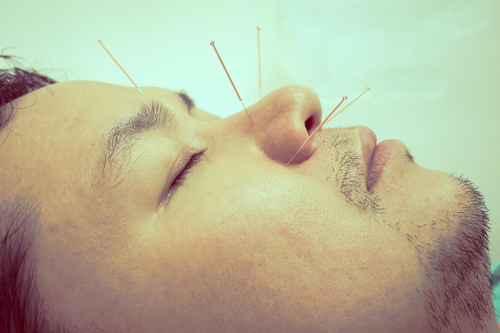 Professional Acupuncture Services in Chicago, IL