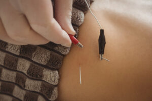 Reliable Acupuncture Services in Chicago, IL