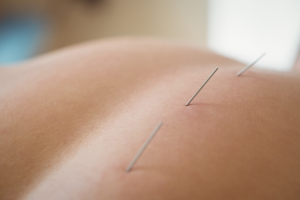 How to Choose the Best Acupuncturist in Chicago, IL for Your Health Needs