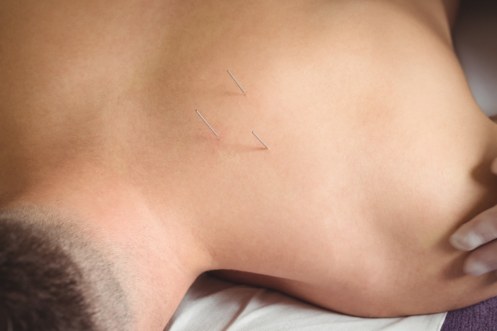 How Often Should You Get Acupuncture for Pain Relief in Chicago, IL