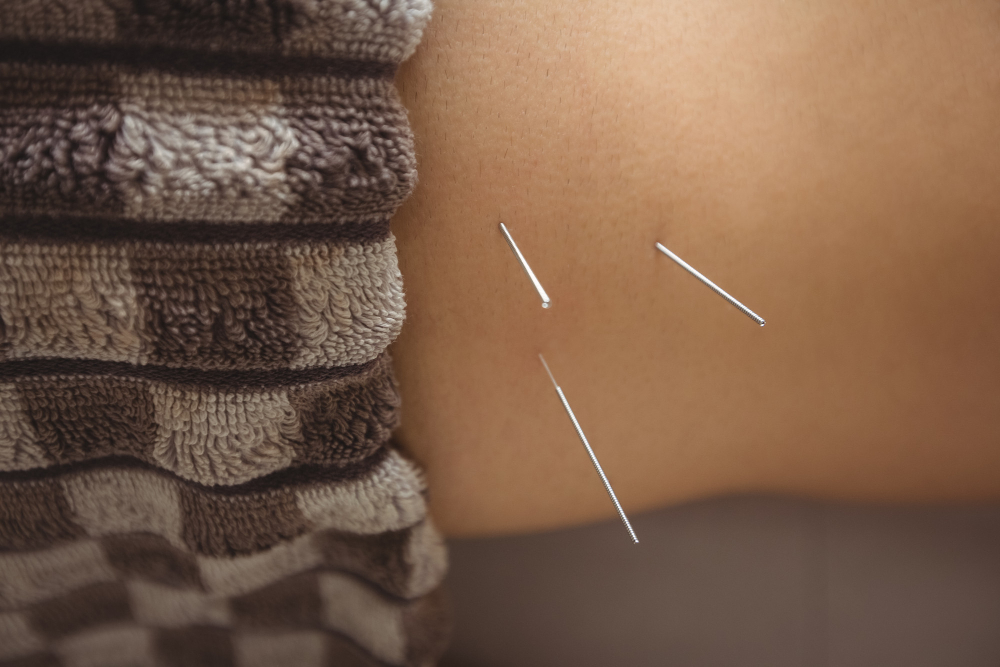 How Often Should You Get Acupuncture for Pain Relief in Chicago, IL