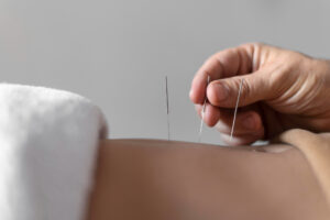 Safe Acupuncture Treatment in Chicago