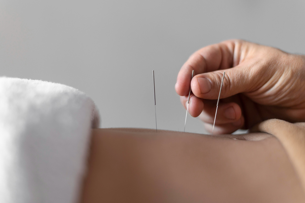 Safe Acupuncture Treatment in Chicago