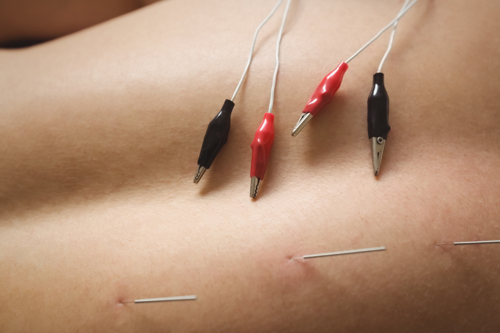 Acupuncture for Back Pain in Chicago