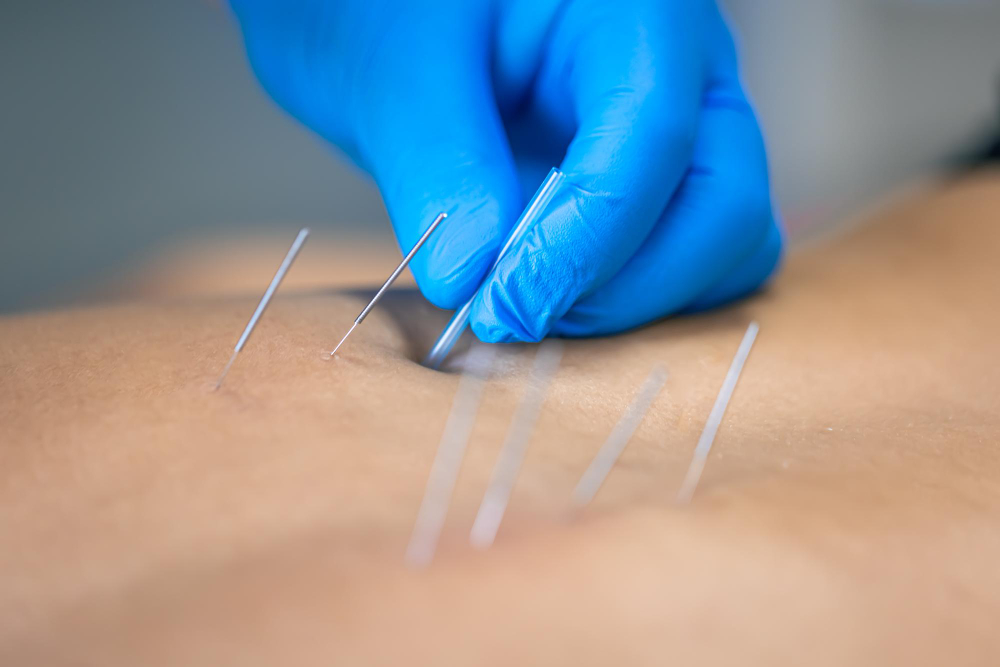 Acupuncture for Back Pain in Chicago